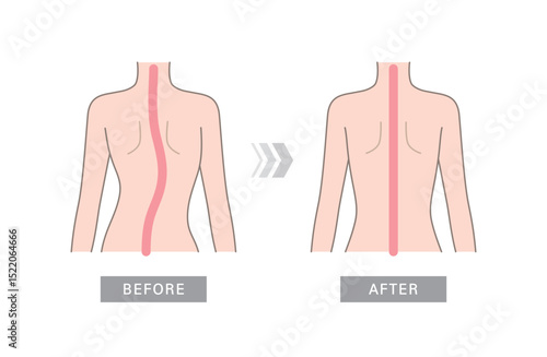 Curved human spine and back. Illustration of scoliosis, normal spine and one with defects
