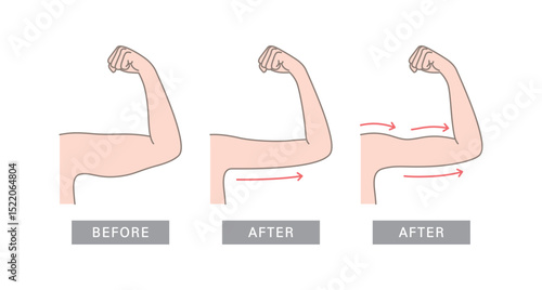 Woman body shape transformation, Fat To Fit. Saggy skin removal and arm before and after toning exercises