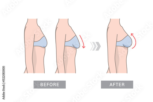Female breast before and after plastic surgery. Breast augmentation vector illustration side view
