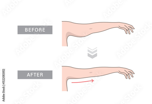 Woman body shape transformation, Fat To Fit. Saggy skin removal and arm before and after toning exercises