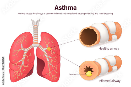 Asthma. Comparison between normal bronchioles and bronchioles with constriction and inflammation. Human respiratory system.