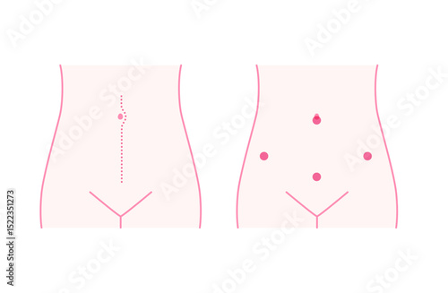 婦人科手術後の腹部イメージ（開腹手術・腹腔鏡手術）