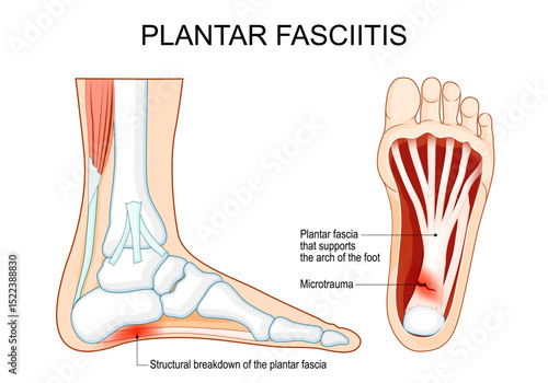 Plantar fasciitis. Heel pain. Human foot