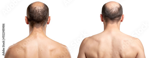 Rear Profile of Bald Male Scalp Transparent Background
