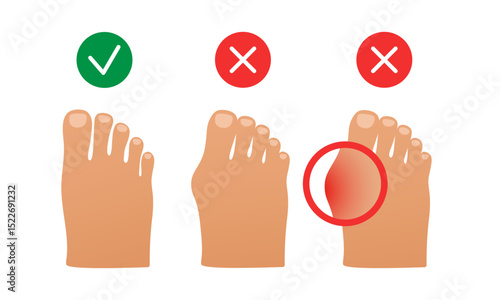 Hallux valgus. Valgus deformity of the big toe joint. Vector illustration.