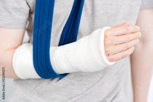Broken Arm in White Cast and Blue Sling