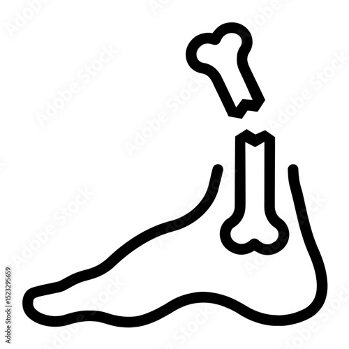 Foot Bone Fracture with Broken Tibia and Fibula — Calcium Deficiency, Bone Health Issues, Osteoporosis, Medical Symbol for Injury, Orthopedic Problems, Skeletal Fragility, Trauma Diagnosis
