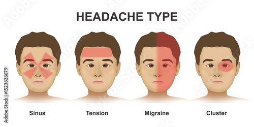 Headache type, Cluster, Migrane, Tension and Sinus