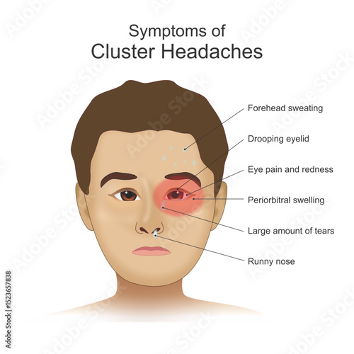 Cluster Headaches its symptoms