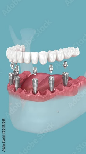 Mandibular prosthesis fixation over six implants. Medically accurate 3D animation