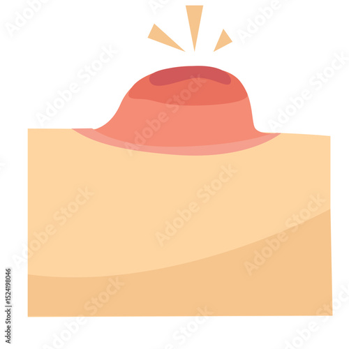 Pustule acne vector. A pimple rises above the skin, circle illustration. Purulent inflammatio