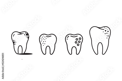 Stages of Tooth Decay Illustrated for Dental Care