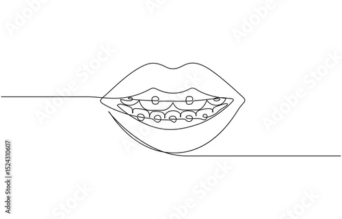 Continuous line drawing of braces for teeth. Vector illustration as line art outline, One continuous drawing of dental aligners. Dental care. Vector illustration.