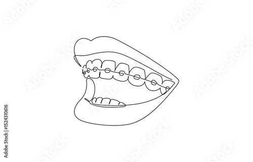 Continuous line drawing of braces for teeth. Vector illustration as line art outline, One continuous drawing of dental aligners. Dental care. Vector illustration.
