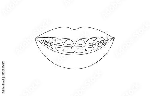 Continuous line drawing of braces for teeth. Vector illustration as line art outline, One continuous drawing of dental aligners. Dental care. Vector illustration.
