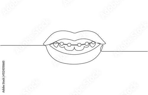 Continuous line drawing of braces for teeth. Vector illustration as line art outline, One continuous drawing of dental aligners. Dental care. Vector illustration.