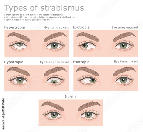 Four types of strabismus and normal human eyes. Vector illustration, medical series. 