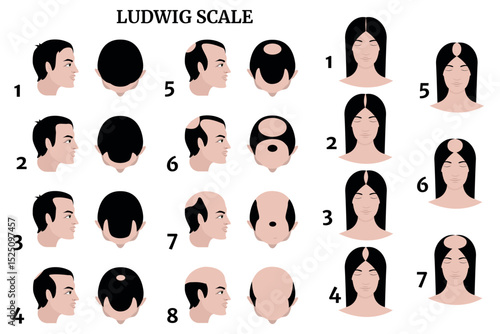 Ludwig scale illustration showing stages of hair loss in men and women. Baldness progression diagram, male and female pattern hair loss chart, front and top view, medical reference image