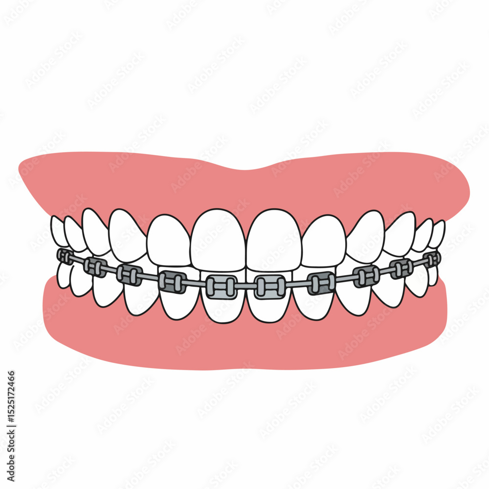 Orthodontic braces on healthy teeth, top and bottom rows, shown on pink gums. Metal brackets and wires align teeth for straight smile. Image suitable for dental brochures, orthodontic practices, Orthodontic braces on healthy teeth, top and bottom rows, shown on pink gums. Metal brackets and wires align teeth for straight smile. Image suitable for dental brochures, orthodontic practices,