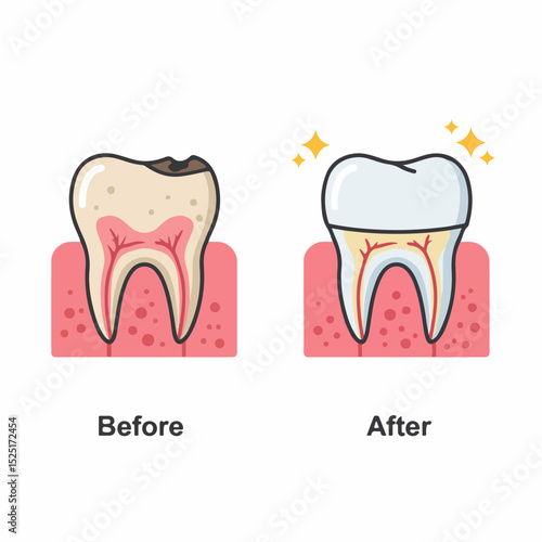 Dental crown before and after tooth restoration.  Damaged tooth with decay is shown before treatment, then healthy tooth with crown after dental procedure.  Illustrative comparison for dental clinics,