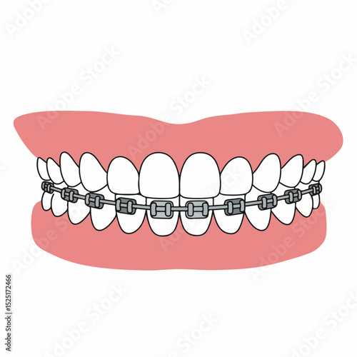 Orthodontic braces on healthy teeth, top and bottom rows, shown on pink gums. Metal brackets and wires align teeth for straight smile. Image suitable for dental brochures, orthodontic practices,