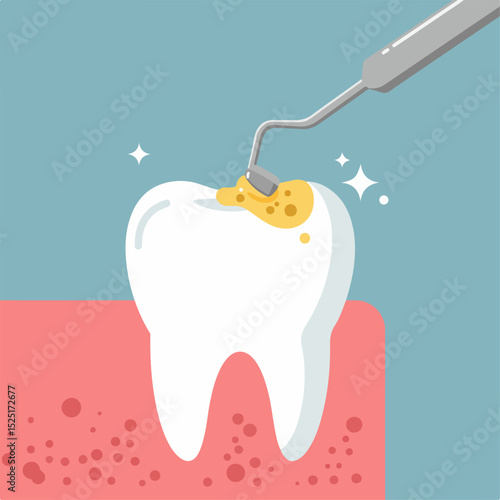Dental cleaning illustration showing tooth with plaque removal.  A dental tool carefully removes yellow plaque from tooth surface.
