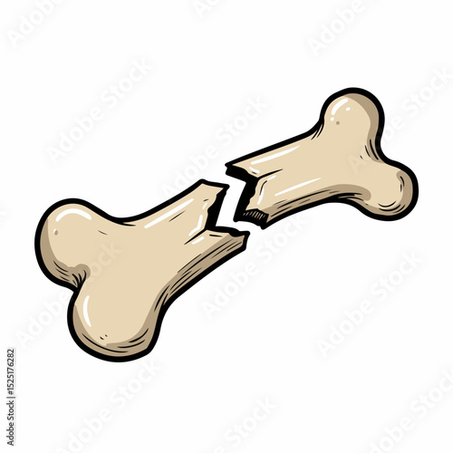 Broken bone illustration.  Graphic design of fractured bone shows sharp edges and jagged fracture line.  Detailed image of broken bone suitable for medical publications, educational materials,