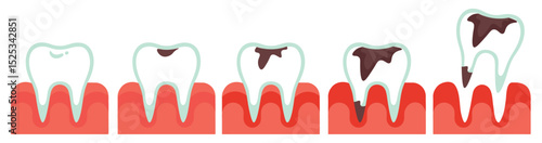 A healthy tooth, a tooth with caries. Stages of tooth caries development from healthy teeth and gums to tooth loss