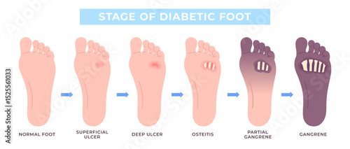 Diabetic foot. Various stages of diabetes feet syndrome. Open wound or deep ulcer, gangrene and necrosis process. Medical info poster racy vector template
