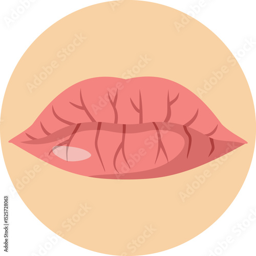 Dry and Cracked Lips Vector Concept Illustration. Cosmetic problem of dryness and dehydration of the mouth 
