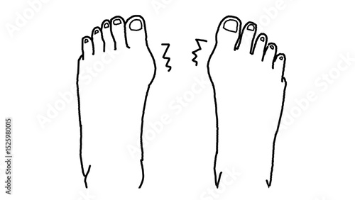 clip art of hallux valgus