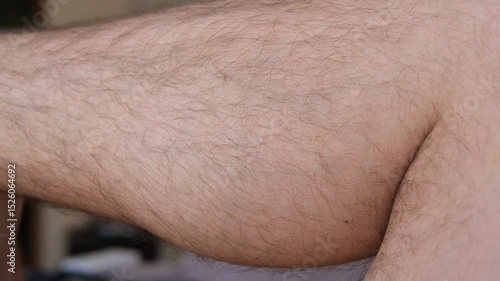 Muscle cramp from overexertion. Contractions of muscle fibers from training