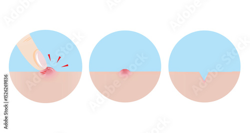 Icon set of pick at pimple with finger, makes turn to icepick scar illustration. Papule, inflammatory acne on skin, squeezing pimple with finger turn to acne scar. Skin care and beauty concept.