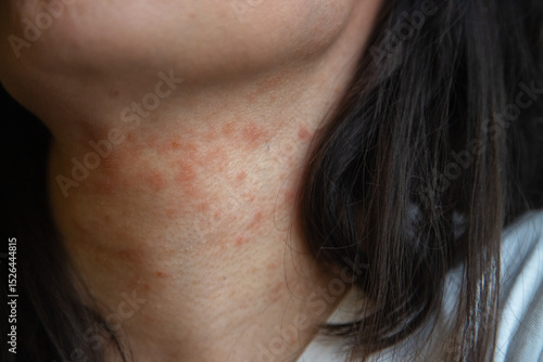 Close-up of a woman’s neck showing an allergic skin reaction with redness and irritation, likely due to eczema or atopic dermatitis. Captured indoors for dermatological reference