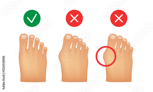 Hallux valgus. Valgus deformity of the big toe joint. Vector illustration.