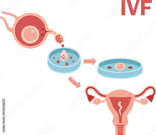 Vector illustration of In vitro fertilization IVF