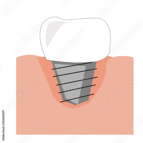 Dental dentures. Dental implant structure. 