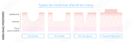 Illustration des types de cicatrices d’acné – avec coupe de la peau