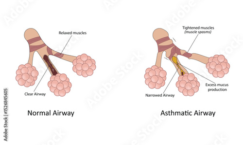 Asthma vector illustration