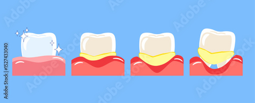 Periodontal disease . Included gingivitis, dental calculus, gum recession and food stuck in teeth . Cartoon illustration . Isolated on blue background . Vector .