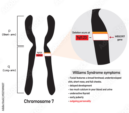 Williams syndrome is a genetic disorder resulting from the loss of multiple genes in the 7q11.23 region of chromosome 7.