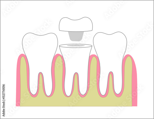 Tooth endocrown concept illustration. Endodontic crown process of installation.