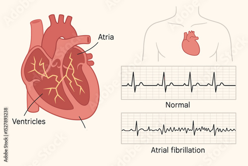 Atrial fibrillation medical illustration comparing a normal rhythm with arrhythmia on an ECG graph. Vector infographic of heart anatomy, atria, ventricles and irregular heartbeat.