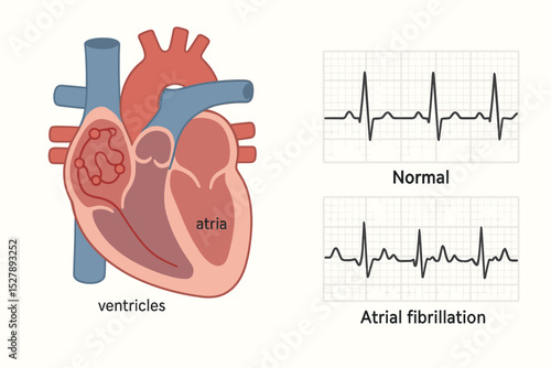 Atrial fibrillation (AFib) vs normal heart rhythm medical vector illustration. Cardiology diagram comparing EKG with irregular arrhythmia and normal sinus rhythm electrocardiogram.