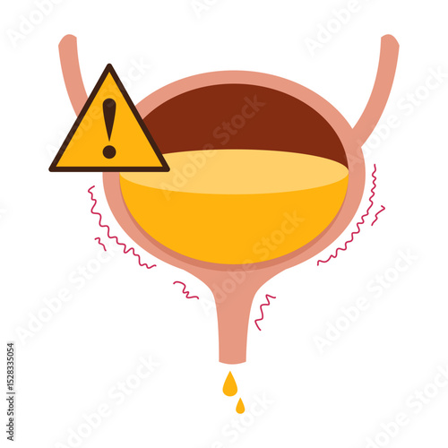 Urinary Incontinence. Overactive bladder. Bladder disease illustration 