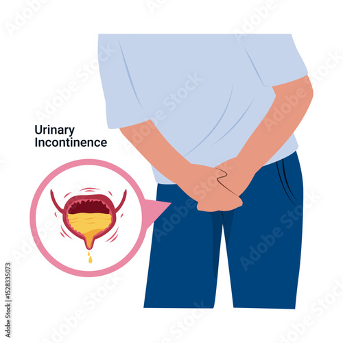 Urinary Incontinence. Overactive bladder. Bladder disease illustration 