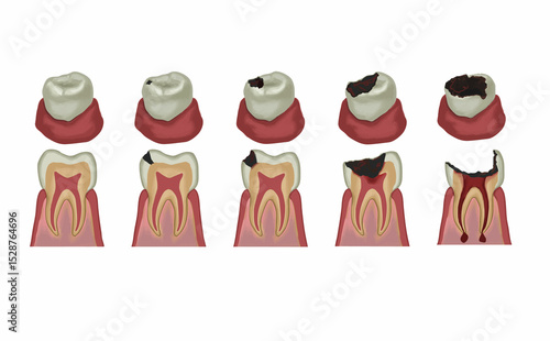 虫歯のステージイラスト