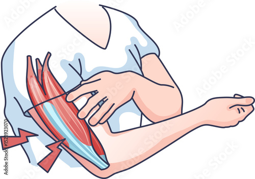 Illustration of arm muscles tensing, highlighting muscle strain and tension.