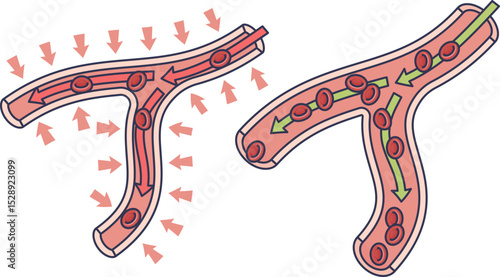 Illustration of blood vessel constriction and normal flow with arrows and red blood cells.