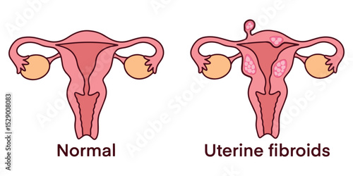 Visual comparison of normal uterus and uterus with fibroid tumors. Used in medical education, patient explanation, and gynecology reference